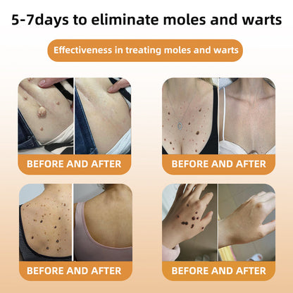 🌿🌿[✨𝐎𝐟𝐟𝐢𝐜𝐢𝐚𝐥 𝐁𝐫𝐚𝐧𝐝 𝐒𝐭𝐨𝐫𝐞✨] ZVLZVL™ Bee Venom Mole and Wart Treatment Spray(👨‍⚕𝐀𝐀𝐃 𝐑𝐄𝐂𝐎𝐌𝐌𝐄𝐍𝐃𝐒)